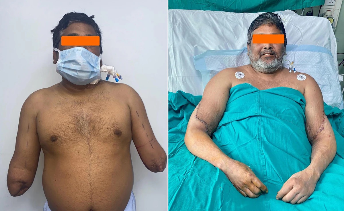 Accident victim gets new hands in rare transplant at Delhi hospital