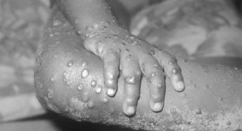 Understanding how mpox spreads is key to controlling an outbreak: Dr Ritu Saxena