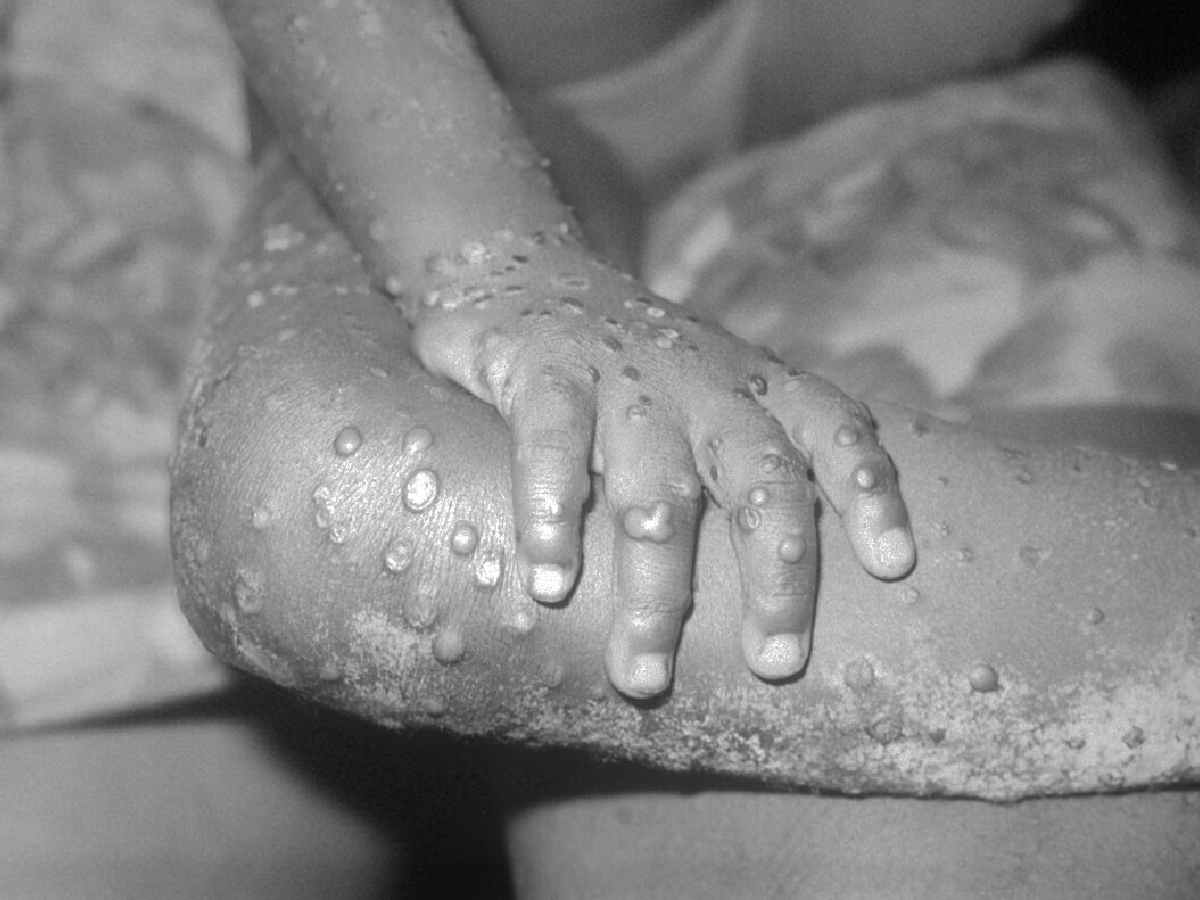 The most recent case of mpox in India was reported from Delhi on September 9