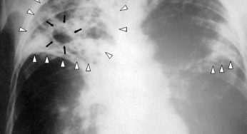 Delhi: TB deaths in Capital nearly double in four year