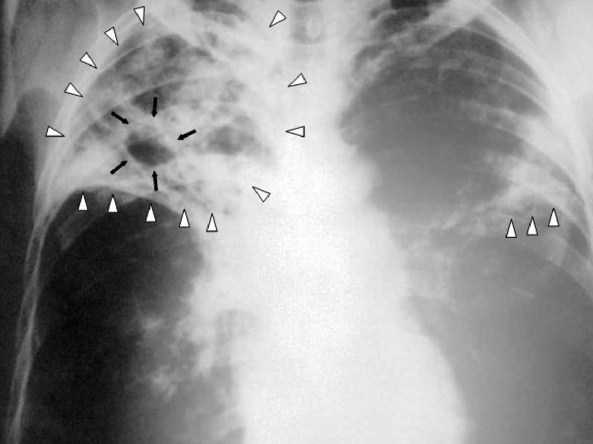 Delhi: TB deaths in Capital nearly double in four year