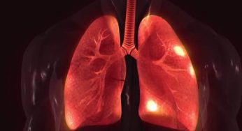 Delhi pollution drives unprecedented rise in COPD cases across hospitals