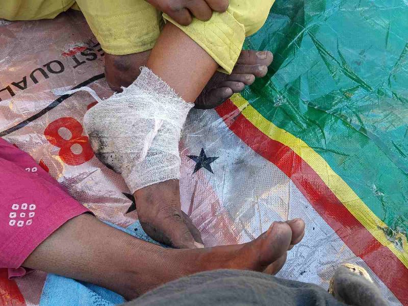 Bruises, cuts, and burns remain as a reminder, as Adina Bibi's daughter becomes the only deceased in the fire incident at Delhi