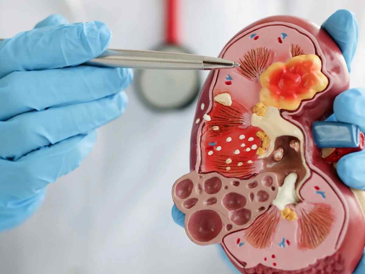 Delhi: Doctors perform kidney transplant on HIV-positive patient