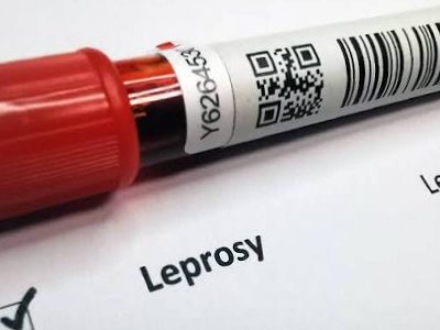 Delhi govt set to declare leprosy a notifiable disease