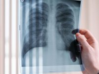 AI-assisted X-rays flag 18,377 people for TB testing in Delhi slums, 877 confirmed: Study