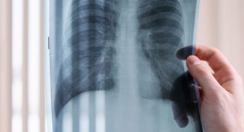 AI-assisted X-rays flag 18,377 people for TB testing in Delhi slums, 877 confirmed: Study