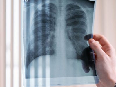 AI-assisted X-rays flag 18,377 people for TB testing in Delhi slums, 877 confirmed: Study