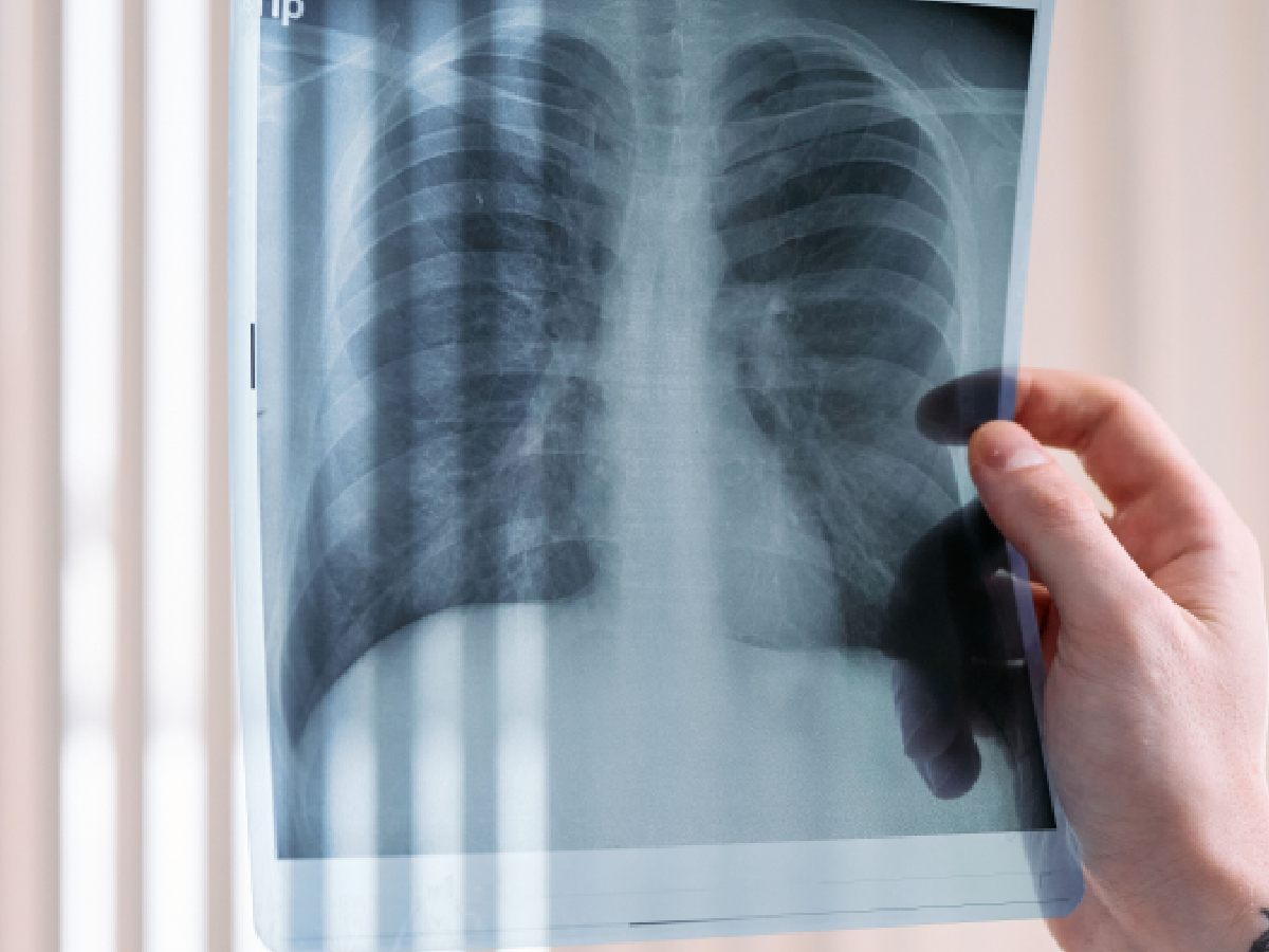 AI-assisted X-rays flag 18,377 people for TB testing in Delhi slums, 877 confirmed: Study